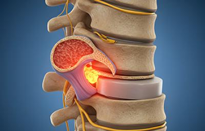 Herniated or Bulging Discs Schedule An Appointment